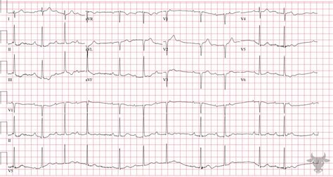 Second Degree Atrioventricular Block – Mobitz I | ECG Stampede
