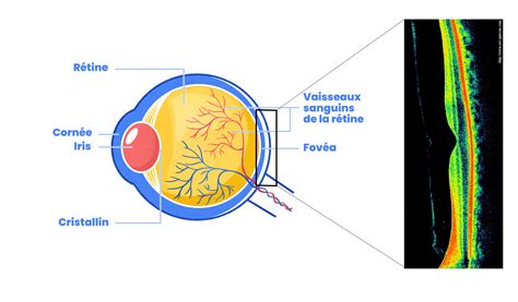 Tomographie à cohérence optique diagnostic de l OMD