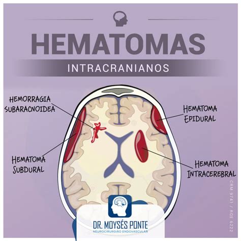 Hematomas Intracranianos Dr Moys S Ponte