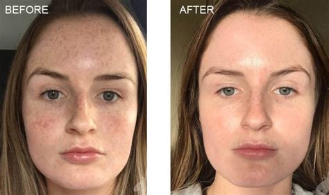 Light Chemical Peel Before And After