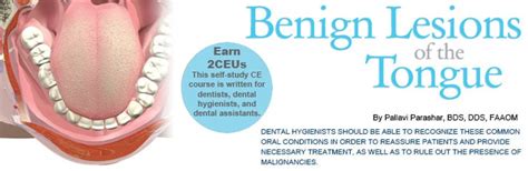 Benign Lesions of the Tongue - Dimensions of Dental Hygiene