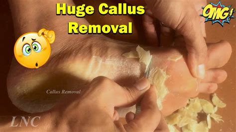 Callus Removal From Feet Satisfying 56 Youtube