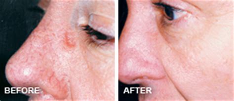 VeinSolutions - Facial Veins