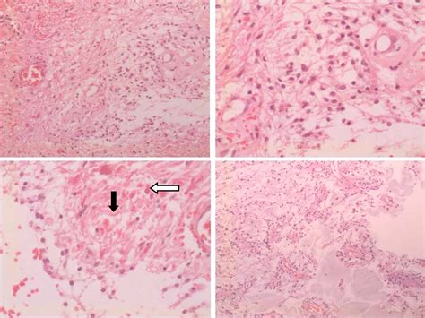 Pilocytic Astrocytoma Anatomic Pathological And Molecular Aspects