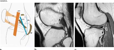 Fibular Collateral Ligament Mri