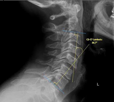 Subaxial Cervical Spine Plain Radiographs Clinical Tree