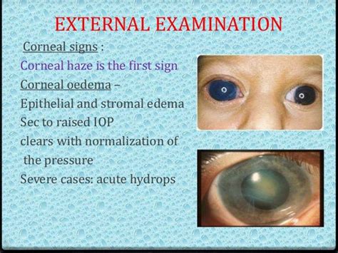 Congenital Glaucoma Part 1