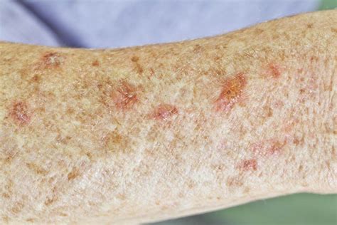 Actinic Keratosis: Symptoms & Cosmetic Care | Viquepedia