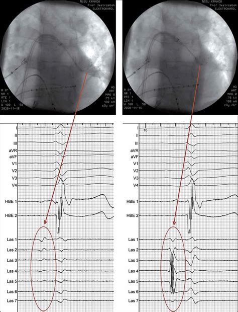 Cryoballoon Pulmonary Vein Isolation As A Standard Approach For Interventional Treatment Of