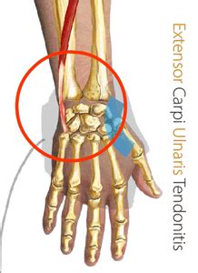 Extensor Carpi Ulnaris Tenosynovitis