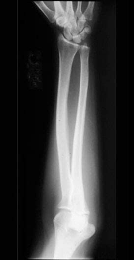 Forearm X Ray Anatomy