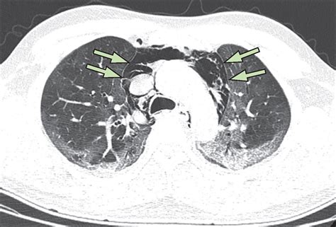 Covid 19 With Spontaneous Pneumomediastinum The Lancet Infectious