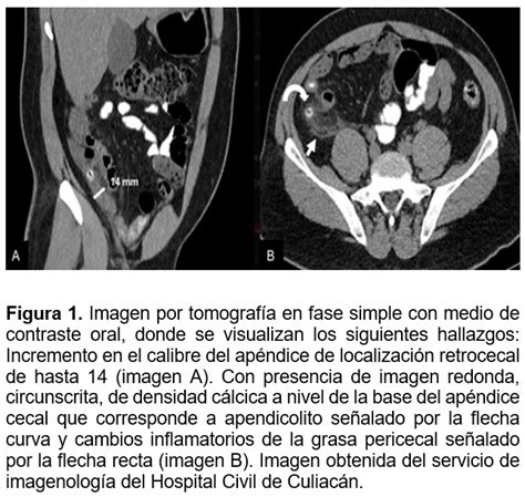 Abdomen Agudo Y Apendicitis 2014 Abdomen Ct Scan Porn Sex Picture