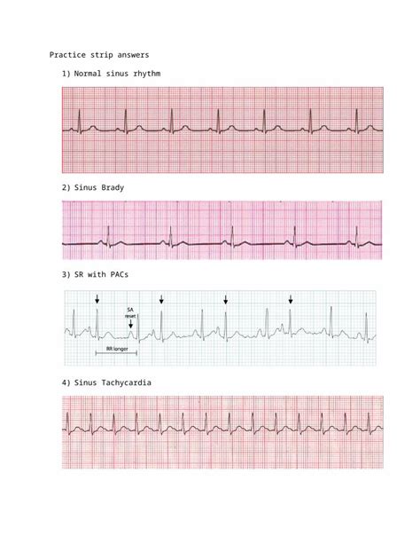 Docx · Web Viewsinus Tachycardia Atrial Fibrillation Atrial Flutter Svt Monomorphic V Tach