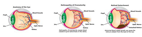 Retinopathy Of Prematurity Aravind Eye Care System