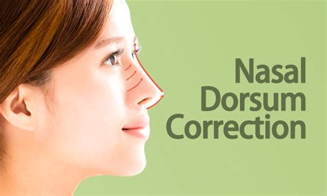 Nasal Dorsum Correction