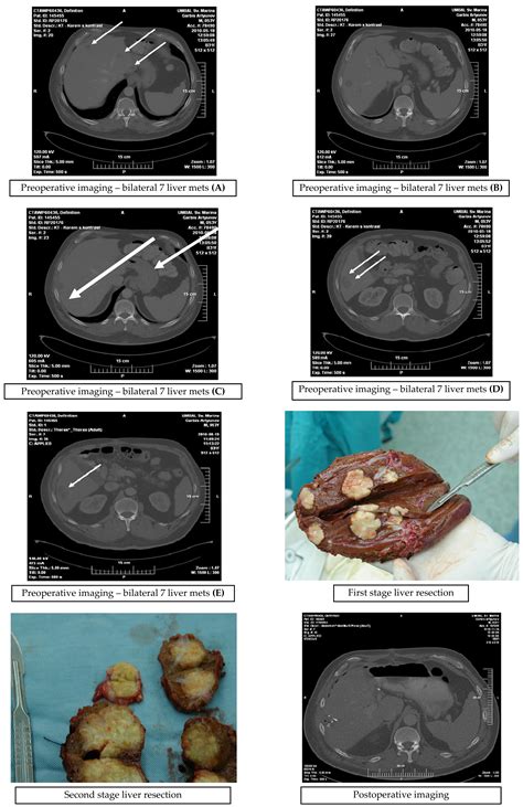 Surgical Strategies For Liver Metastases From Colorectal Cancer Intechopen