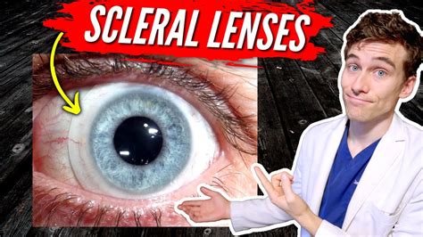 Scleral Lenses For Keratoconus 7 Facts You Need To Know