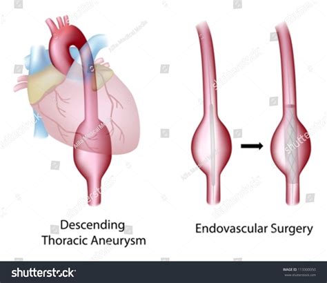 Thoracic Aortic Aneurysm Surgery Stock Vector (Royalty Free) 113300050 ...