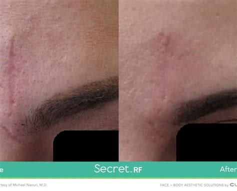 Secret Rf Radio Frequency Microneedling Image Perfect Laser