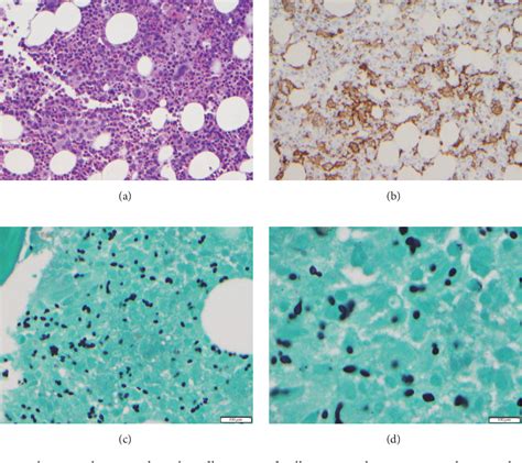 Figure From Histoplasmosis Induced Hemophagocytic Lymphohistiocytosis