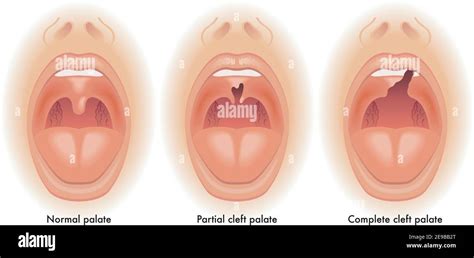 Malformation D Anatomie Banque D Images Vectorielles Alamy