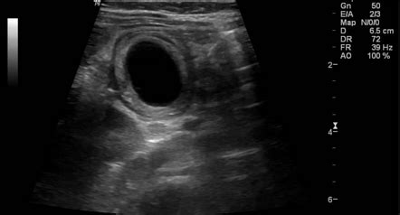 Enteric Duplication Cyst Radiology Case Radiopaedia Org