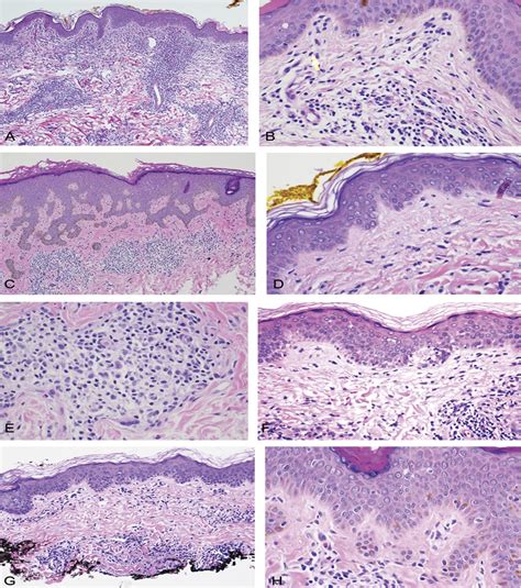 Subtlety Of Granulomatous Mycosis Fungoides A Retrospective The