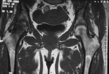 Avascular Necrosis AVN Of The Femoral Head Imaging And Diagnosis