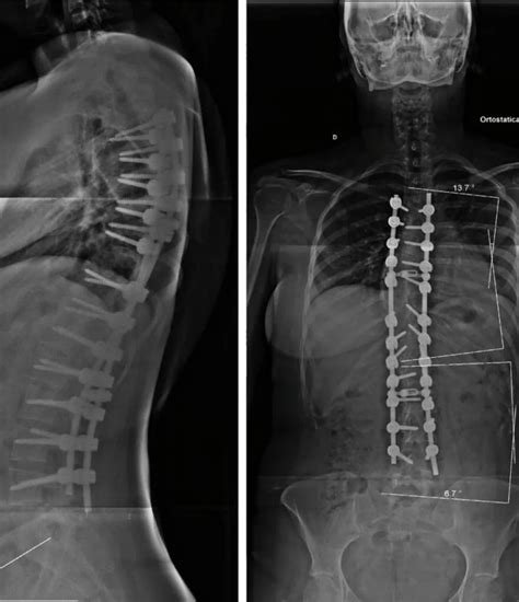 Escoliose Entenda Causas Sintomas Diagn Stico E Tratamentos Dr