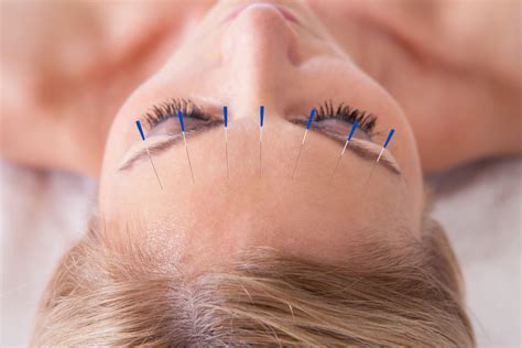 Treating Migraines With Acupuncture Centrespring Md