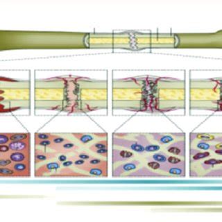 Process of Bone Fracture Healing [1]. | Download Scientific Diagram