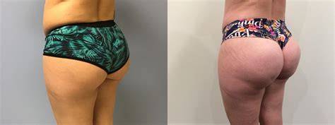 brazilian butt lift dangerous brazilian butt lift  ultimate bbl