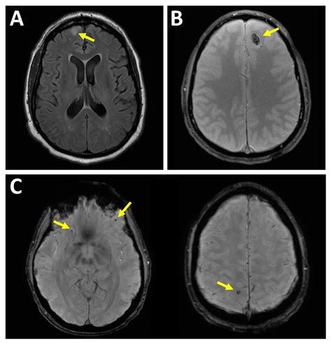 Brain Contusion: Understanding Causes, Symptoms & Treatment