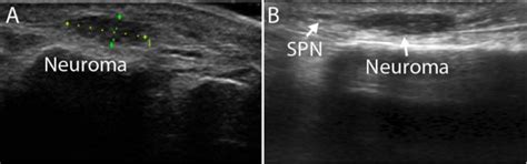 Clinical Outcome For Surgical Treatment Of Traumatic Neuroma With A