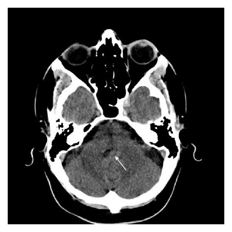 Brain Ct Scan Demonstrating Hyperdense Tumor Arrow Filling The 4th