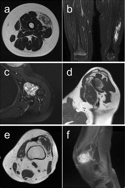 Magnetic Resonance Imaging Mri Axial T2 Weighted Mri A And Coronal