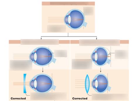 farsighted/nearsighted eye diagram Diagram | Quizlet