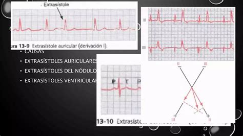 Arritmias cardiacas y su interpretación electrocardiográfica Guyton PPT