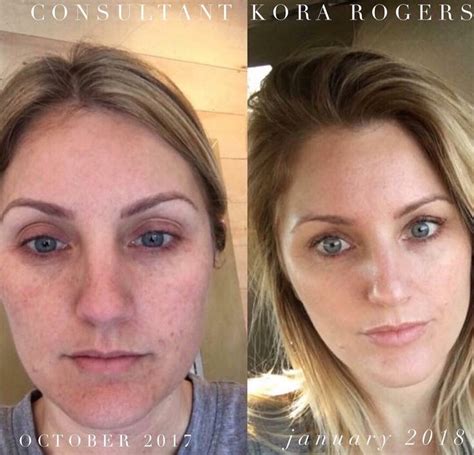 Exposed Skin Care Before And After Lucile Stirrup