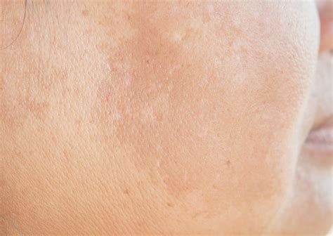 Uneven Skin Tone Ozmedica Aesthetic Clinic Melbourne