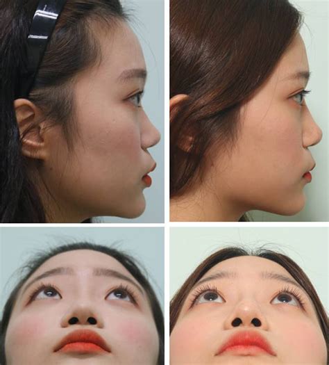 A New Technique In Asian Nasal Tip Plasty Non Incisional Double