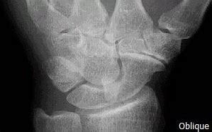 Triquetrum fracture