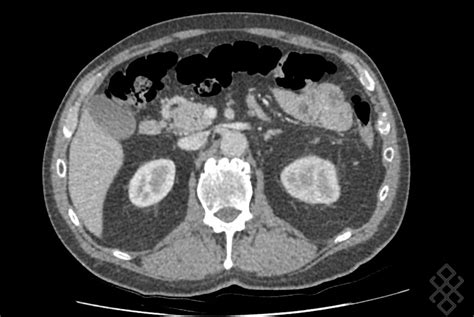 Scanner Abdominal Définition Déroulement Prise de rdv en ligne