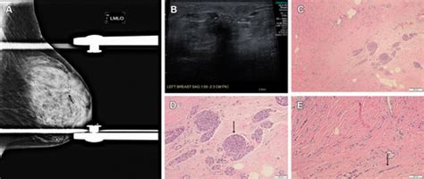 Update On Lobular Neoplasia RadioGraphics