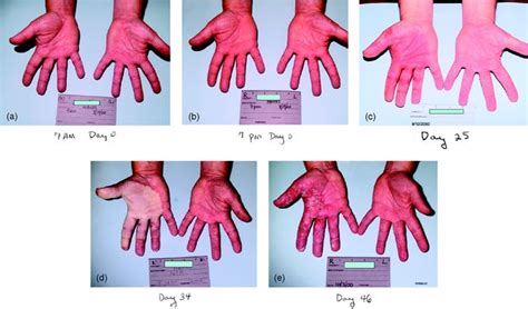 Radiation Accidents And The Medical Management Of Acute Radiation