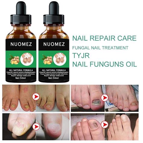 Feet Care Essence Nail Fungal Treatment Anti Infection Paronychia