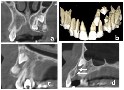 A Coronal Cone Beam Computed Tomography Cbct Scan Showing Impacted