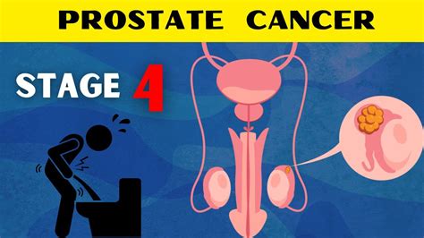 Prostate Cancer Stage 4 Treatment And Side Effects Youtube