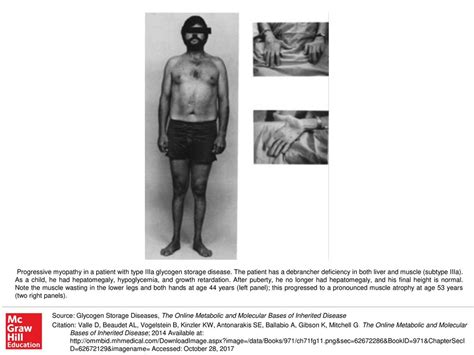 Progressive Myopathy In A Patient With Type Iiia Glycogen Storage